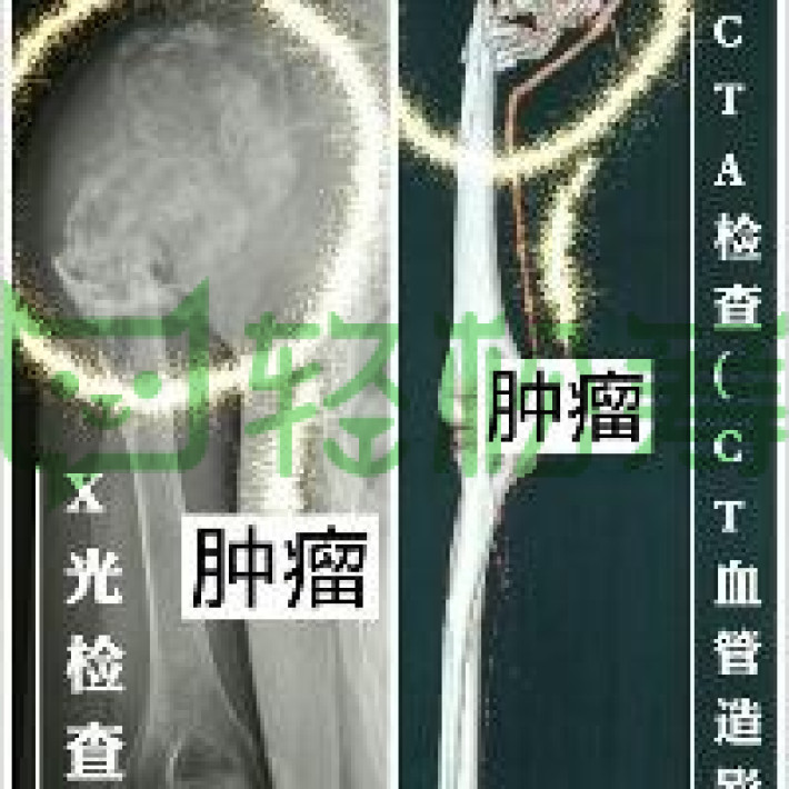 湛江麻章一名孤儿患骨肉癌,七旬爷爷奶奶与其相依为命