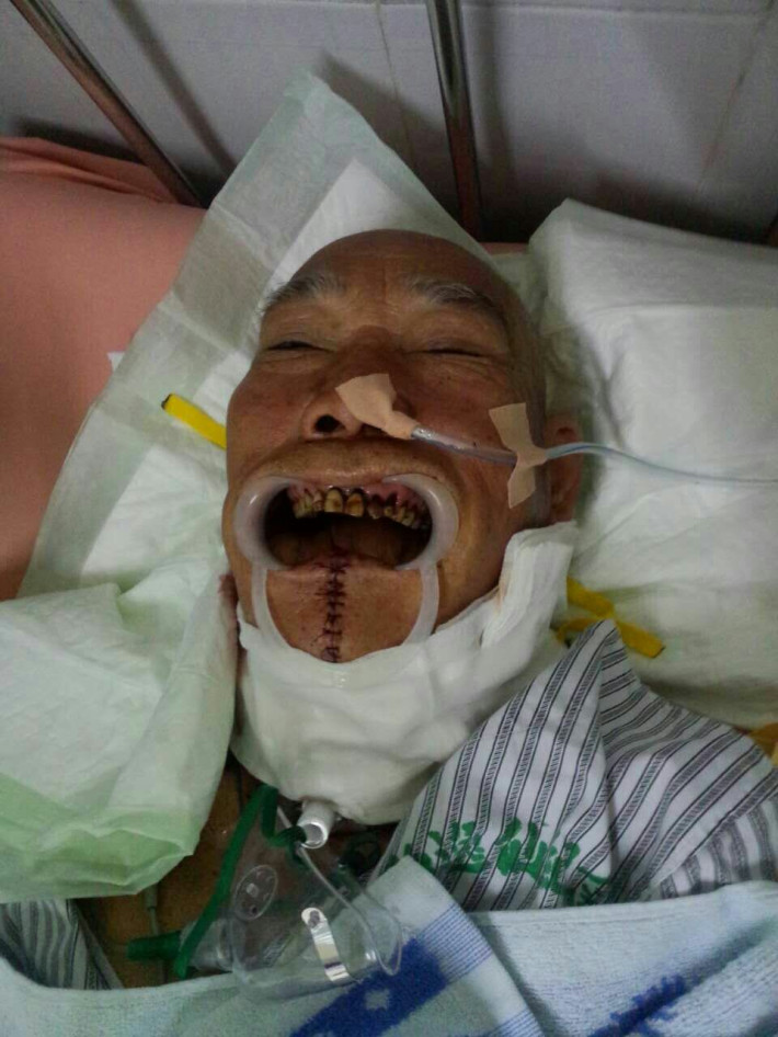 冯其顾,今年59岁,口底癌做13个小时的大手术成功.