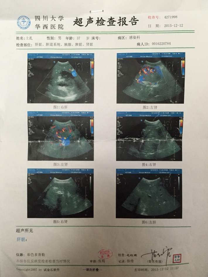 拯救肝,肾包虫(虫癌)患者土扎