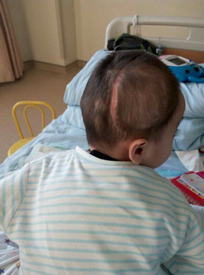 因此病幼儿十分罕见直接转到北京儿童医院做了开颅手术,在重症监护室