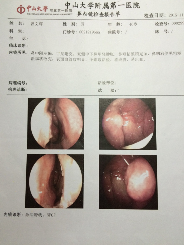 鼻咽癌ct报告图片